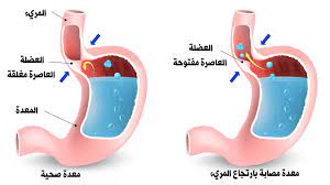 جراحة ارتجاع المريء وفتق الحجاب الحاجز بالمنظار